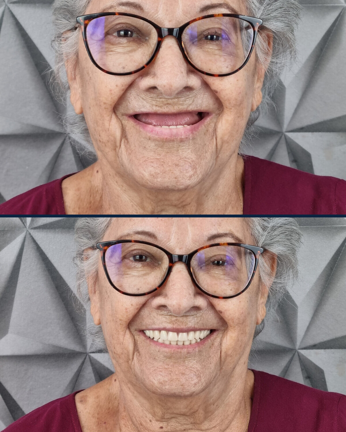 Paciente sorrindo antes e depois da reabilitação com prótese: acima, sorriso com ausência de dentes; abaixo, sorriso renovado com dentes claros e uniformes