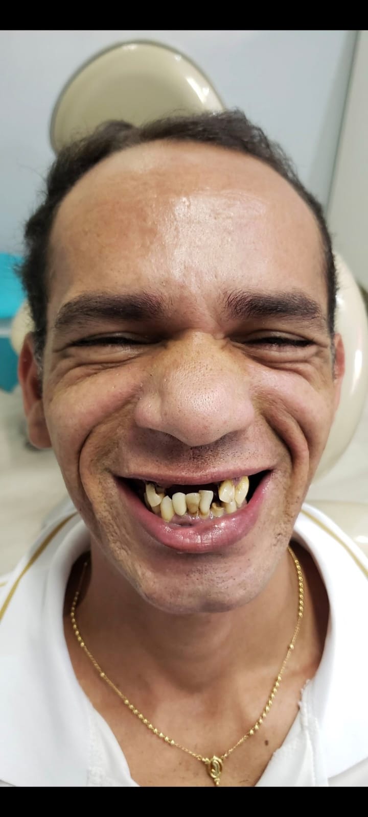 Paciente antes da reabilitação com protocolo sobre implantes, sorrindo com a ausência de vários dentes superiores