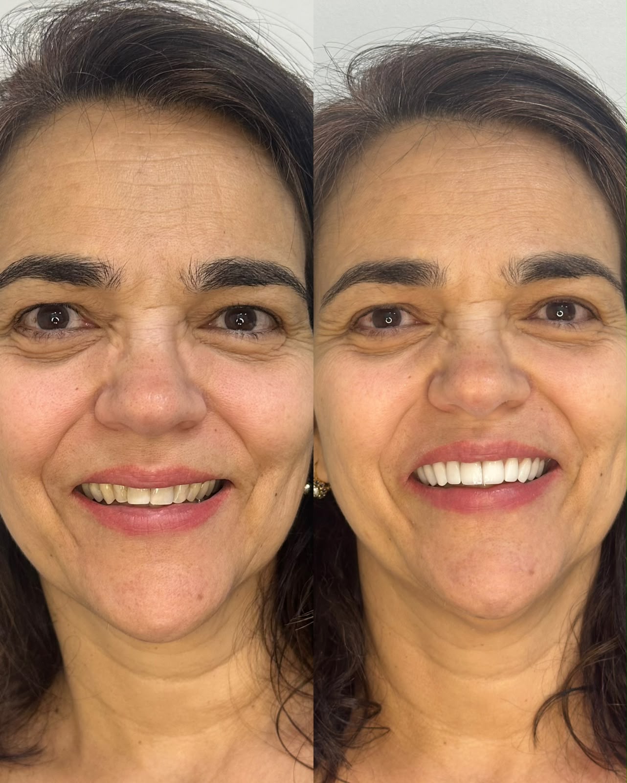 Antes e depois de paciente tratada com facetas em resina na Odontec: à esquerda, sorriso com dentes desgastados e escurecidos; à direita, sorriso renovado, claro e natural