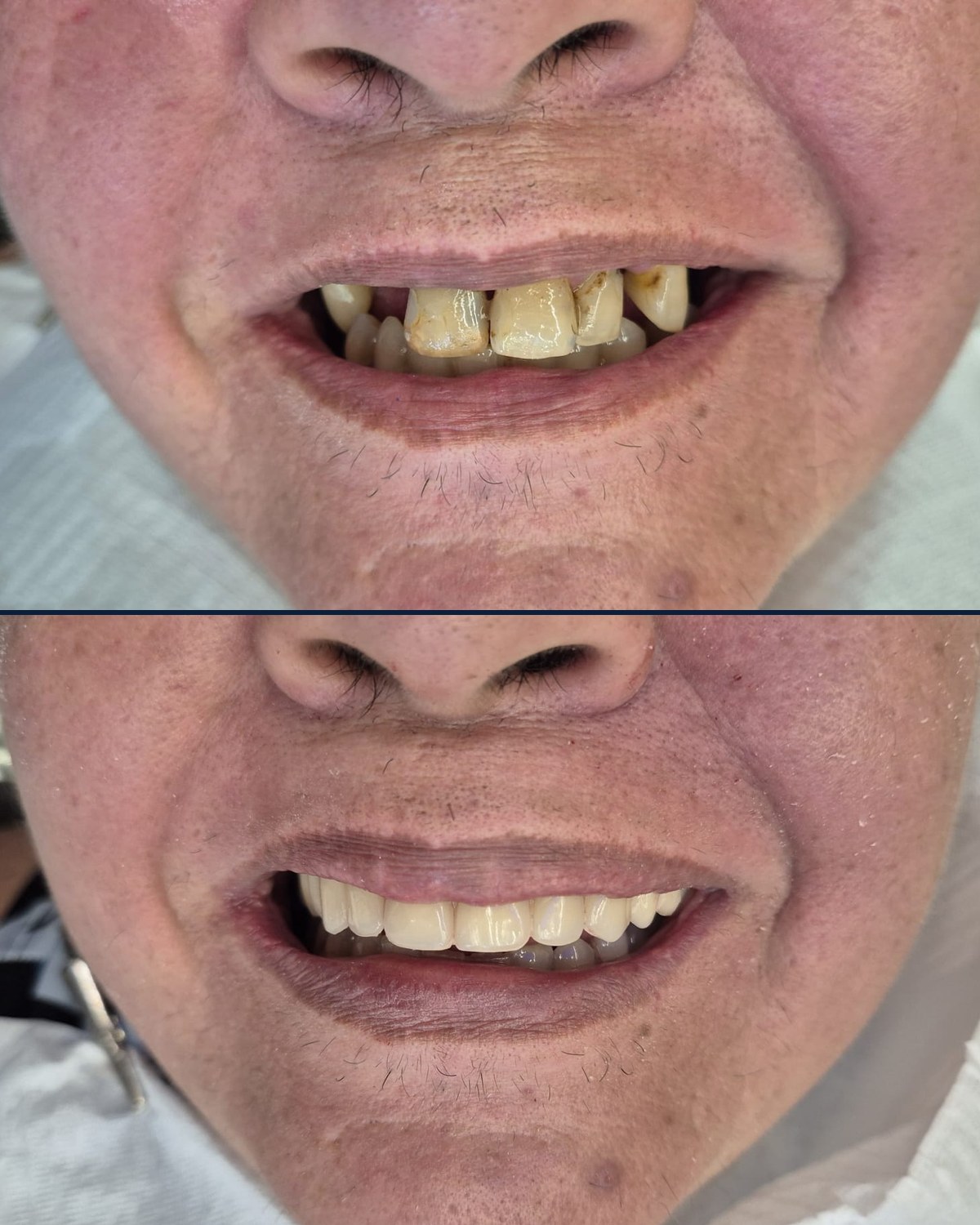 Sorriso de paciente antes e depois da reabilitação com prótese fixa: acima, dentes escurecidos e danificados; abaixo, sorriso novo com dentes claros e uniformes