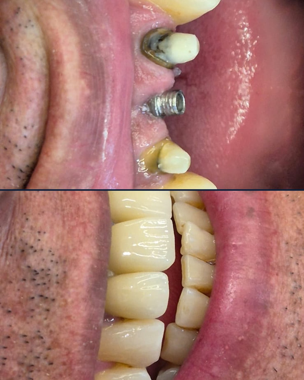 Etapa de implante dentário e resultado final: acima, implante de titânio instalado na gengiva; abaixo, coroas definitivas em oclusão com estética de dente natural